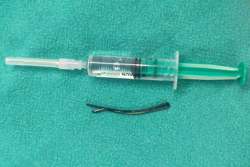 Doctors pull out 6 cm hairpin from 2.5 year old girl in northeastern India