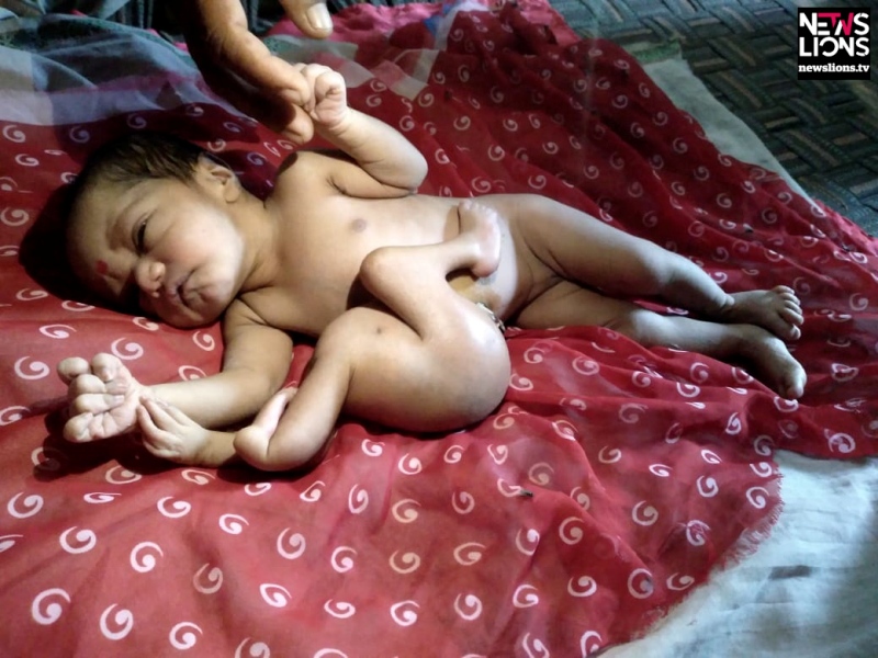 Woman gives birth to child with four pairs of arms, legs in northern India
