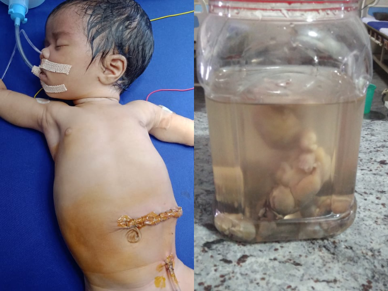 Bizarre! Eight underdeveloped fetuses found in 22-day-old baby’s stomach in eastern India