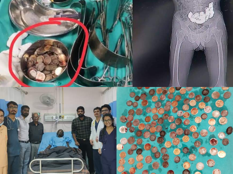 Doctors remove 187 coins from man’s stomach in southern India