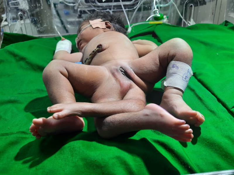 Woman gives birth to four-legged girl in central India