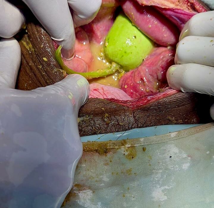 Doctors extract bottle gourd from patient’s rectal cavity in central India